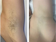 Hair Removal