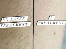 Hair removal - Before and After