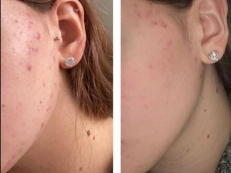 Acne skin treatment - Before and After