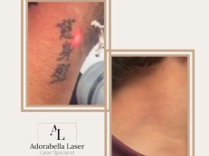 Tattoo Removal - Before And After