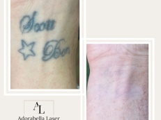 Tattoo Removal - Before And After