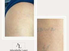 Tattoo Removal - Before And After