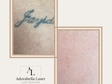 Tattoo Removal - Before And After