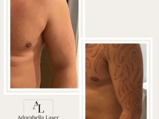 Tattoo Removal - Before And After