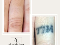 Tattoo Removal - Before And After