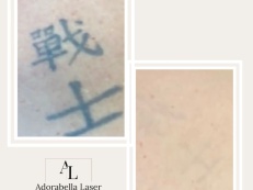 Tattoo Removal - Before And After