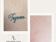 Tattoo Removal - Before And After