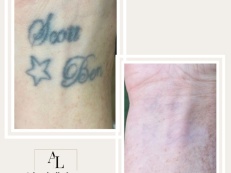 Tattoo Removal - Before And After