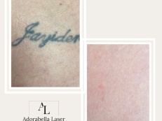 Tattoo Removal - Before And After