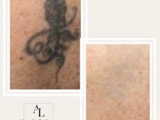 Tattoo Removal - Before And After