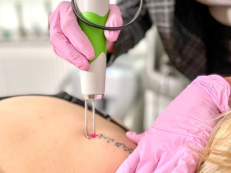 Laser Tattoo Removal