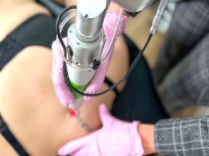 Tattoo Removal Machine