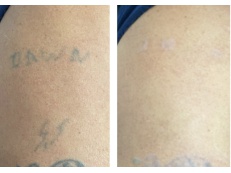 Tattoo Removal