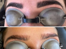 Eyebrow Hair Removal - Before And After