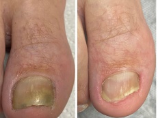 Fungal Toenail Before & After