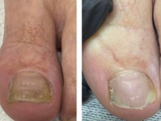 Before & After Fungal Toenail