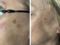 Age Spot / Pigmentation Removal